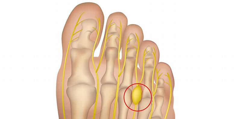 Diagram for Mortons neuroma in the foot