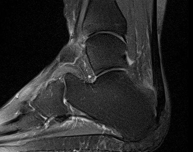 Achilles tendon scan